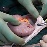 Woww..!! Universitas Al-Azhar Mesir Halalkan Transplantasi Ginjal Babi ke Manusia..!!