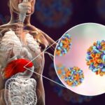 Kemenkes Ingatkan Dinkes Daerah Waspadai Penyakit Hepatitis Misterius..!!