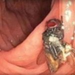Hiii…Seramm..!! Lalat Hidup di dalam Usus Pasien Kanker, Dokter Pun Bingung..!!